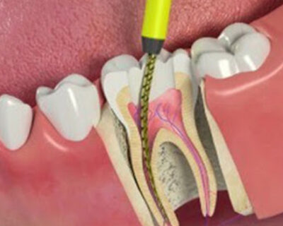 painfree-root-canal-treatment