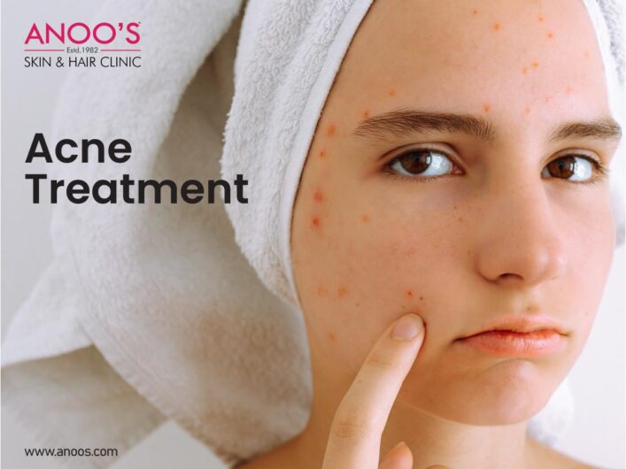 Clear Skin with Anoos Acne Removal Treatment