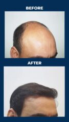Hair-Transplant-07-12-2024-1-1