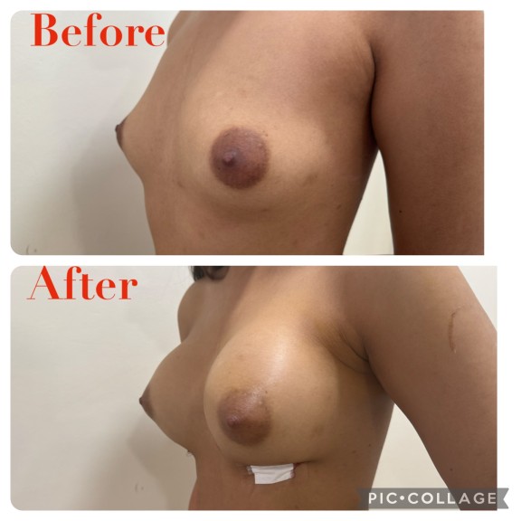 Laser Liposuction, Breast Implants & Cosmetic Surgery Near Me In Hyderabad