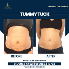 Tummy-Tuck-30-09-2025-1