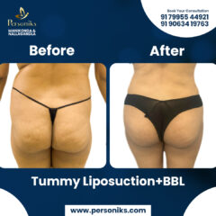 Tummy-Lipo-with-BBL-25-10-2025-1