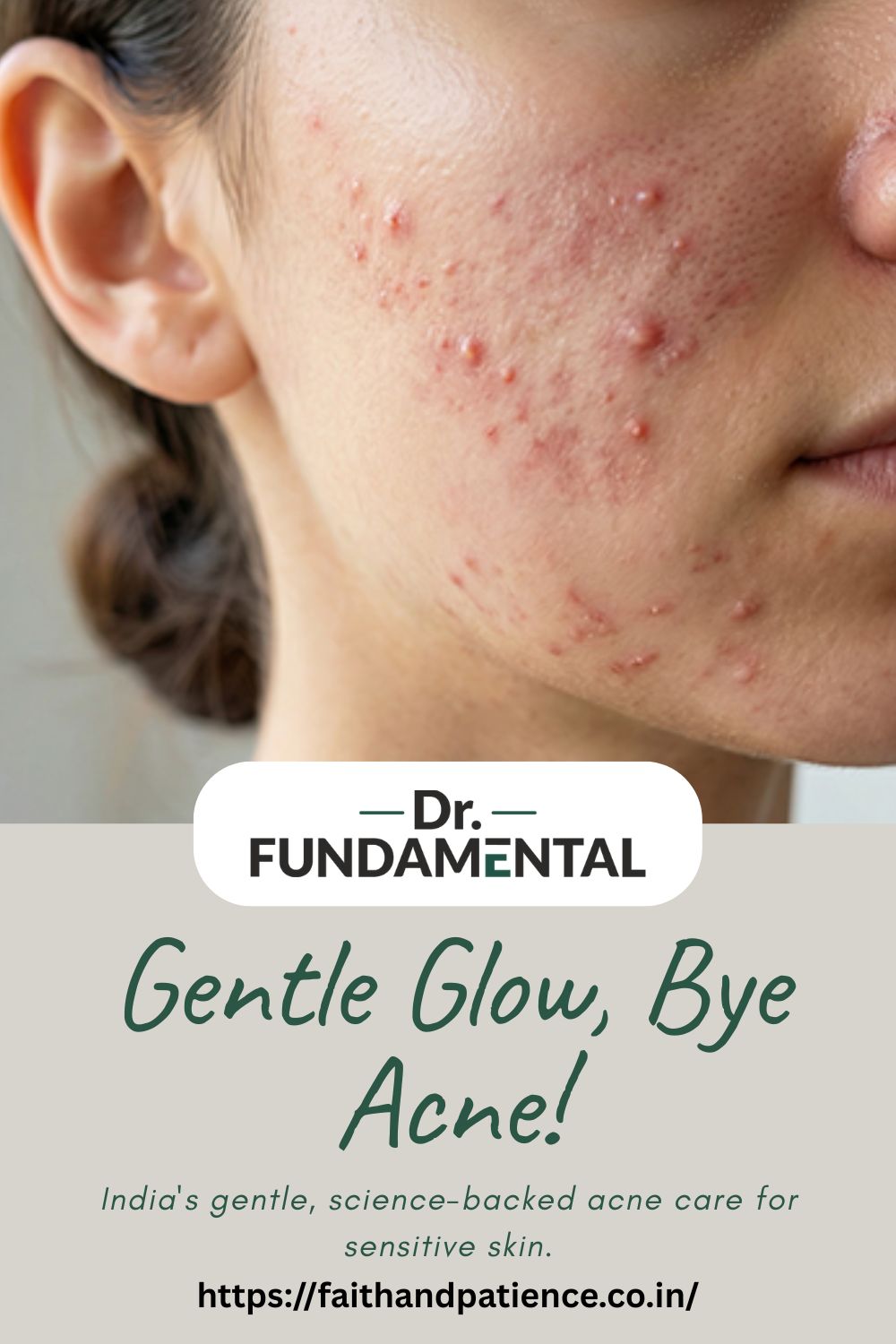 Gentle Glow, Bye Acne!