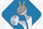 High-Quality Hip Replacement Implants Manufacturer in India | Sharma Orthopedic