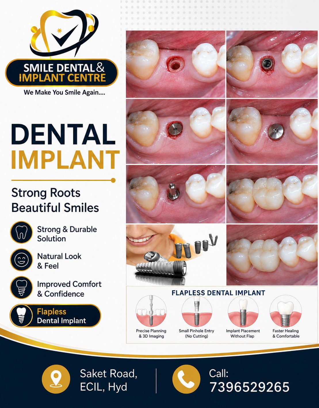 Flapless Dental Implant Near Me: A Modern Approach to Tooth Replacement