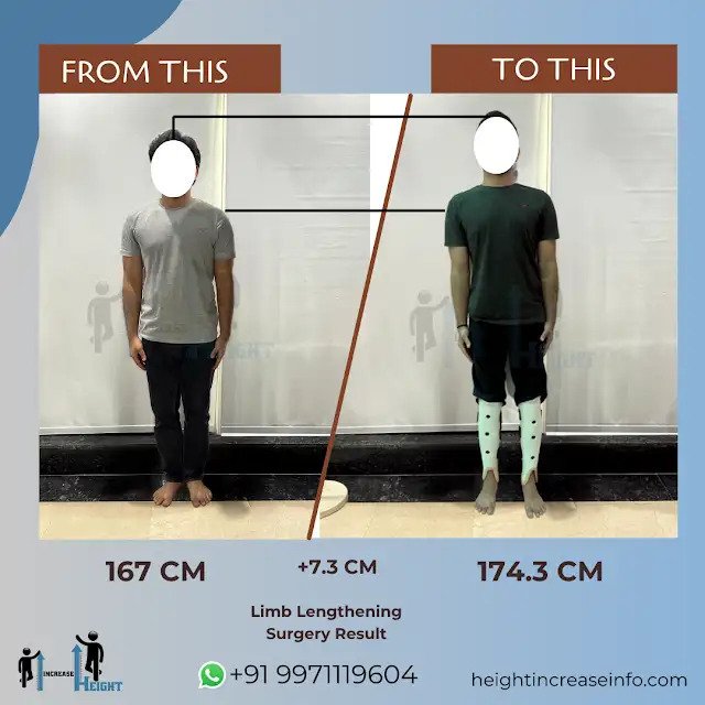 Height Increase Surgery in Gurgaon, India